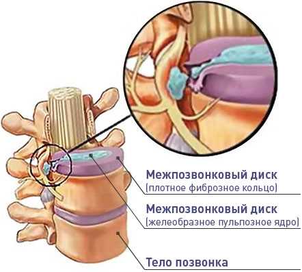 Как распознать чревную грыжу симптомы и диагностика
