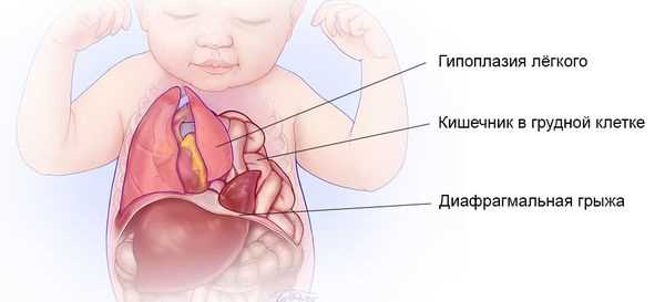 Как распознать диафрагмальную грыжу и правильно реагировать на симптомы