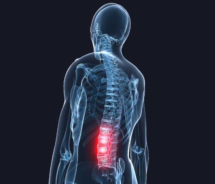 Влияние стресса на развитие грыжи