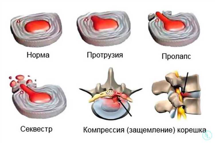 Способы снижения риска осложнений при грыже