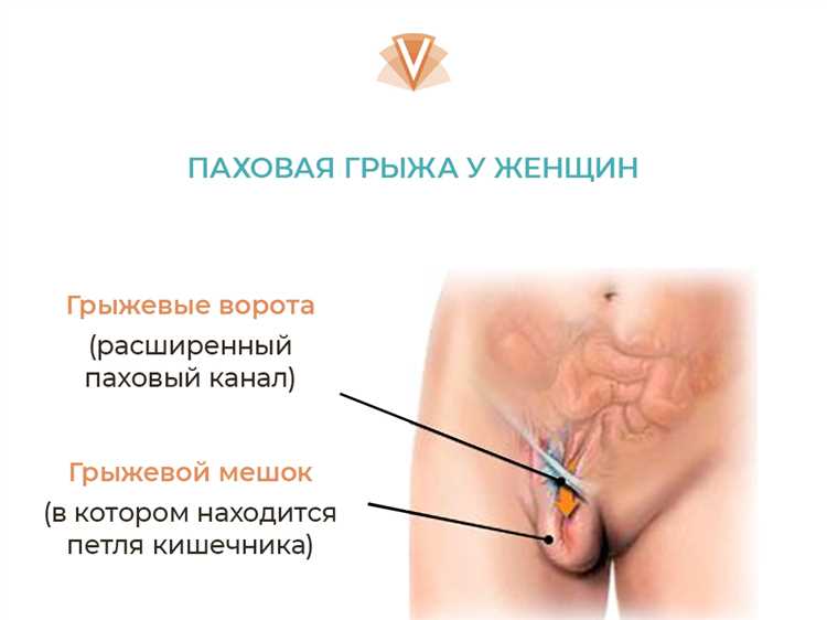 Как определить наличие грыжи по рекомендациям врачей