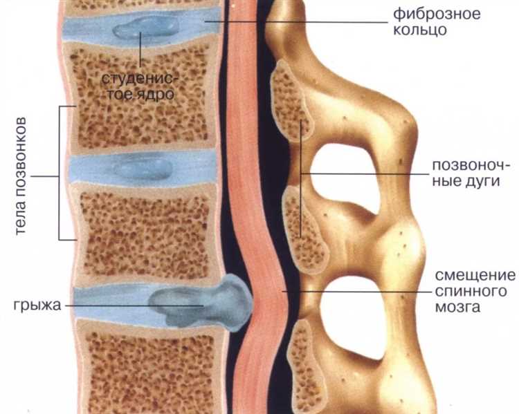 Как выбрать эффективный курс лечения при грыже