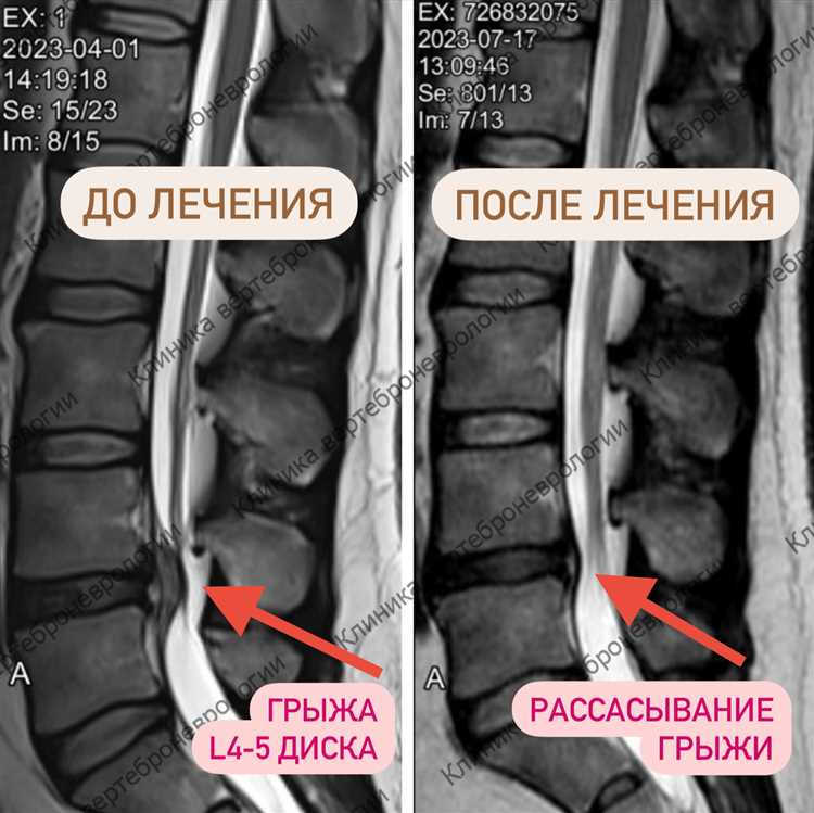 Влияние возраста на эффективность лечения грыжи