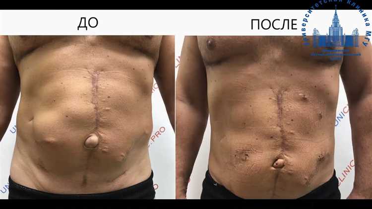 Способы восстановления здоровья после лечения грыжи