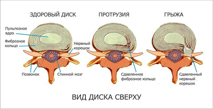 Современные подходы и инновации в лечении грыж по клиническим рекомендациям