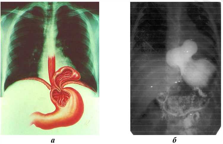 Ключевые методы визуализации для диагностики грыжи