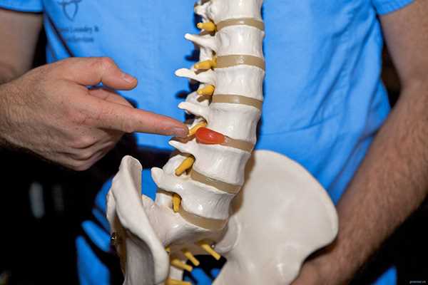 Когда необходимо проводить операцию при грыже и какие есть ограничения