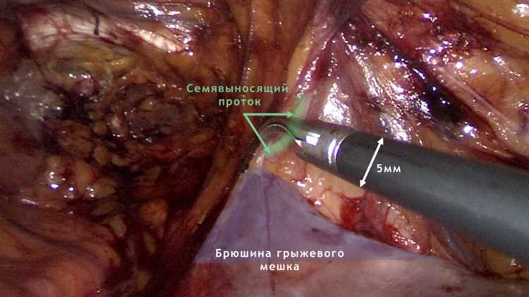 Когда требуется открытая операция при грыже Показания и противопоказания