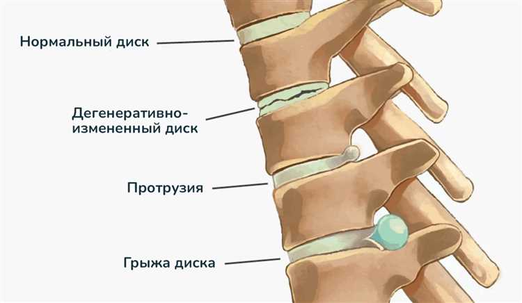Консультация специалиста по лечению грыжи на различных стадиях