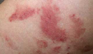 красные пятна на коже