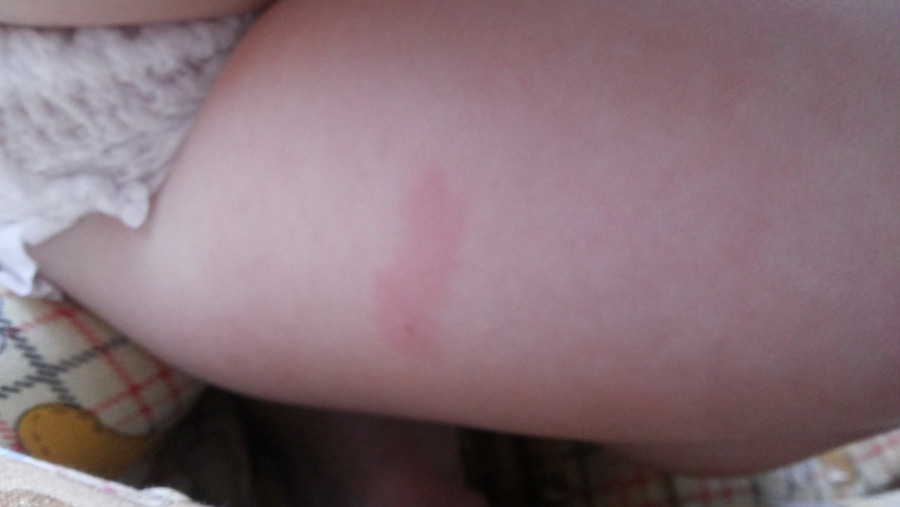 покраснение места укола