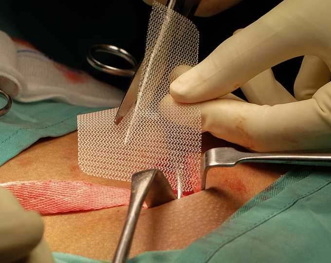 Лапароскопическая операция по лечению грыжи преимущества и особенности