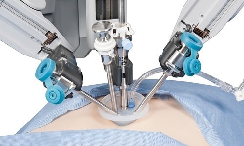 Лапароскопия проводится у мужчин и женщин, путем создания небольших проколов на животе