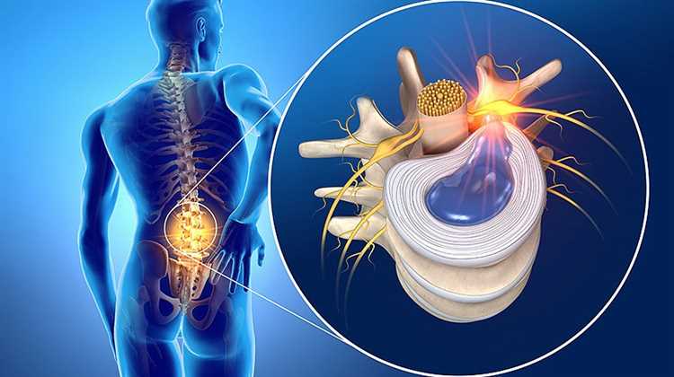 Современные методы лечения грыжи без операции