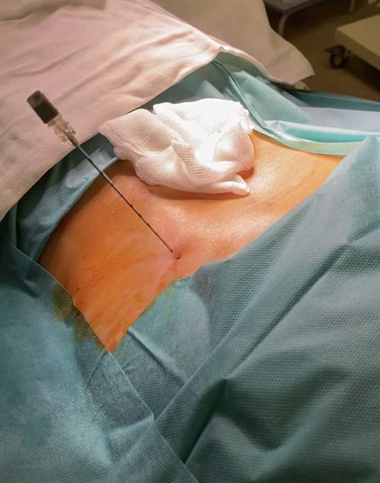 Грыжа без операции Как добиться успешного лечения