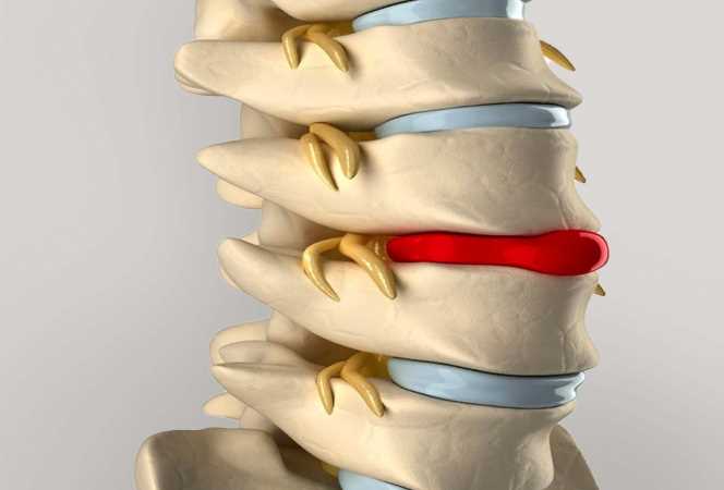Эффективные методы лечения грыжи без операции от опытных пациентов