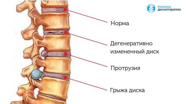 Эффективные методы лечения грыжи без операции и полезные советы