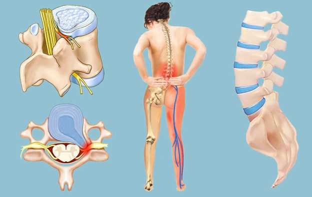 Лечение грыжи без операции действительно возможно