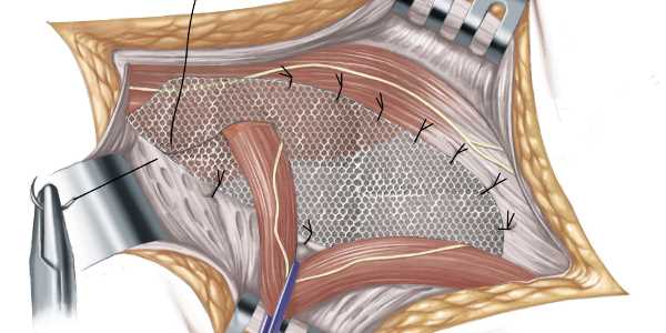 Выбор между операцией и консервативной терапией при лечении грыжи
