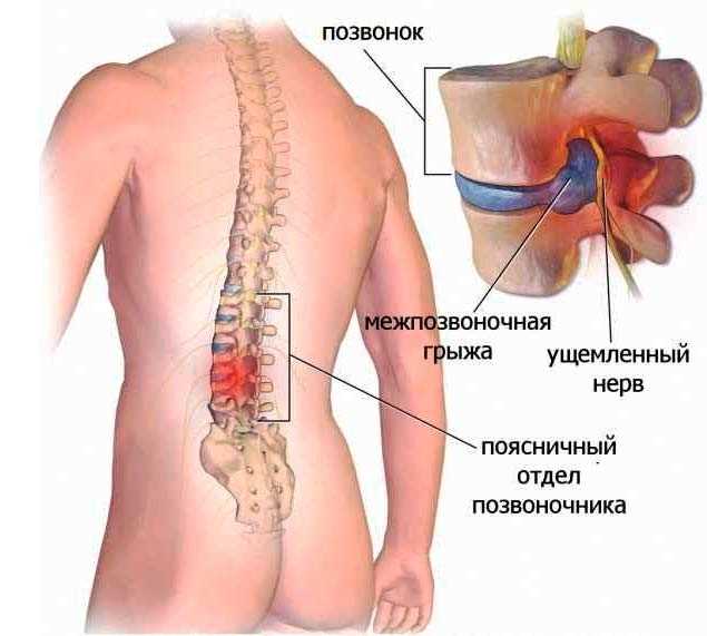 Лечение грыжи поясничного отдела симптомы и советы