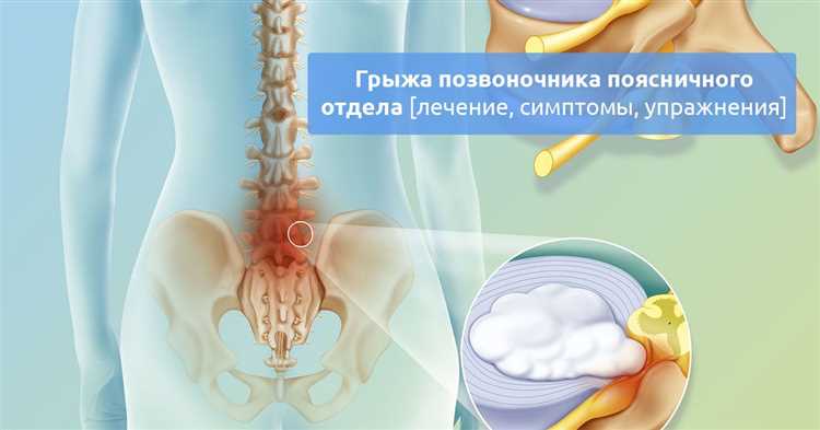 Безопасное лечение грыжи в домашних условиях рекомендации и возможные риски