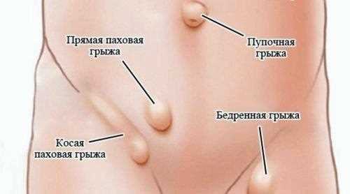 Лечение грыжи у взрослых и детей какие существуют различия
