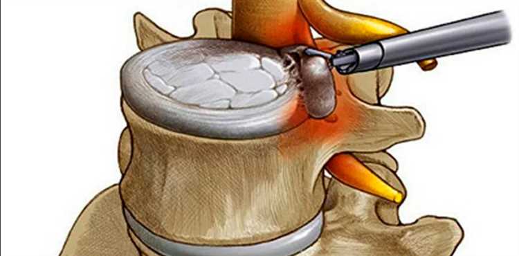 Сравнение методов лечения грыжи в разных странах