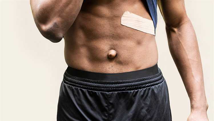 Лечение пупочной грыжи без операции возможно