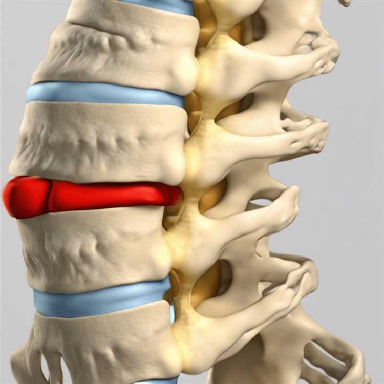 Эффективные народные средства для лечения грыжи в домашних условиях