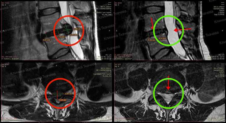 Лекарства при грыже что назначают врачи