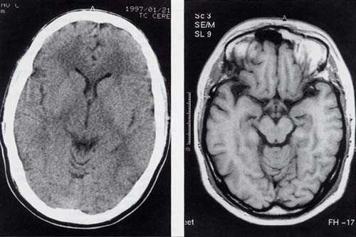 Сравнение методов визуализации грыжи УЗИ МРТ и КТ