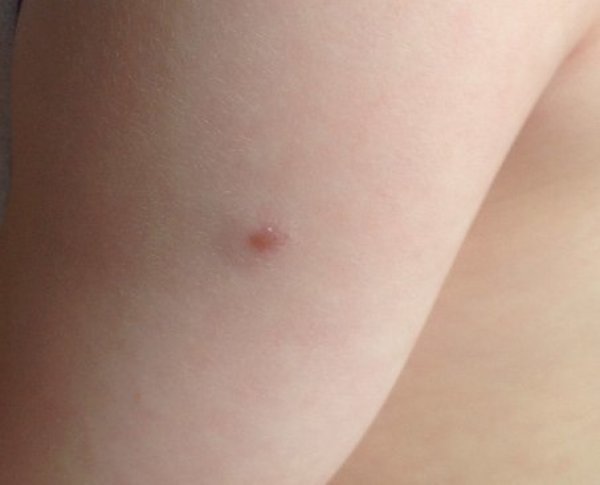 место укола