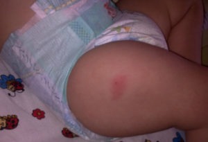 место укола