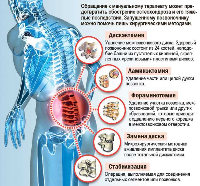 Эффективные методики мануальной терапии при лечении грыжи
