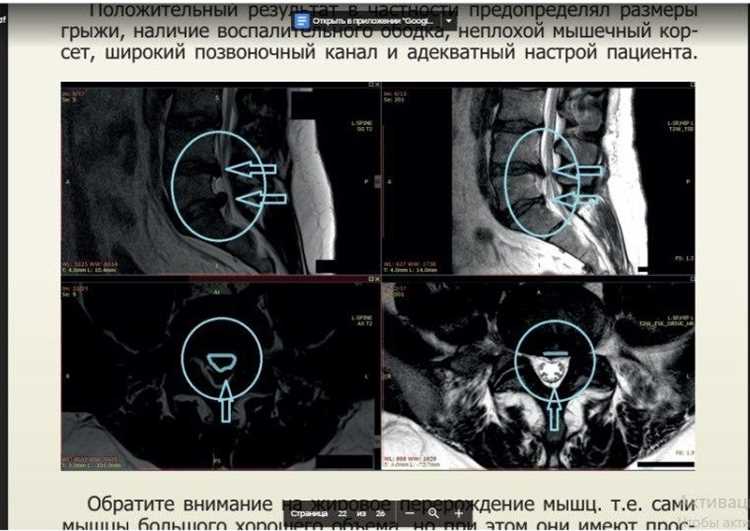 Развенчиваем мифы о лечении паховых грыж без операции