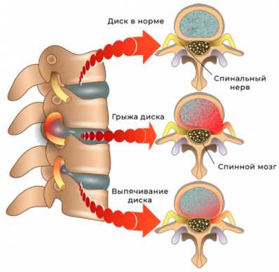 Мой путь к выздоровлению и борьбе с грыжей