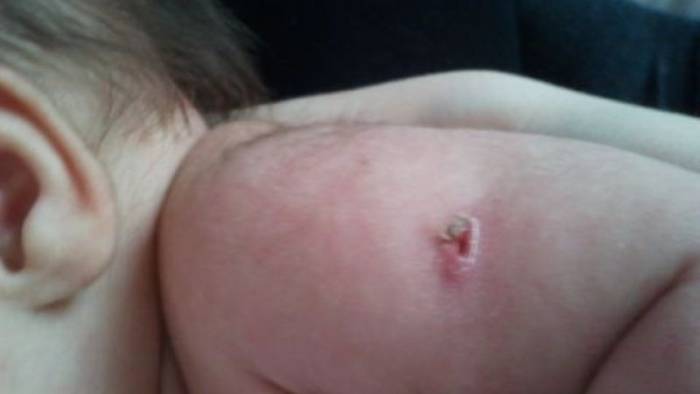 нагноение на месте прививки