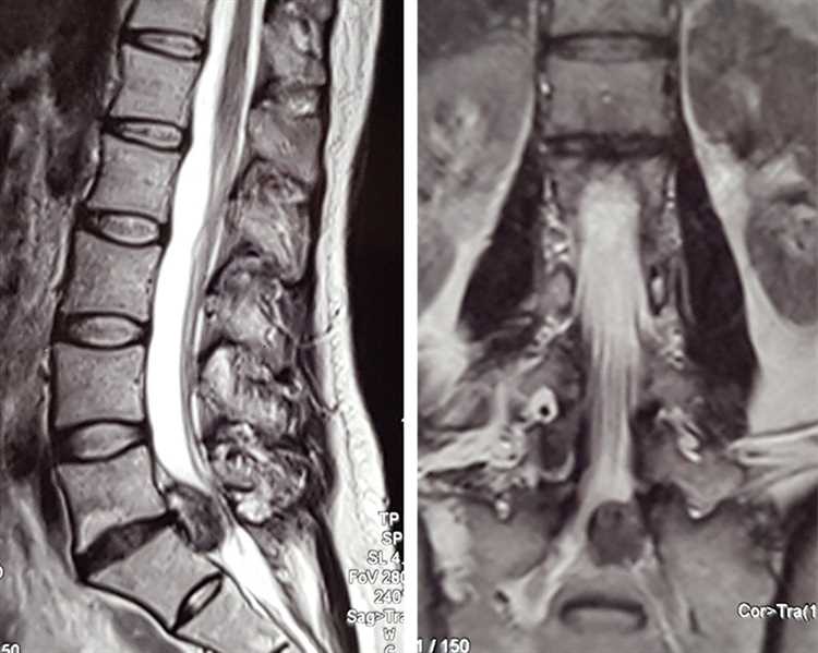 Эффективность медикаментозной терапии при грыже