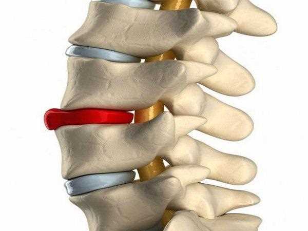 Нервные окончания и грыжа взаимосвязь и методы лечения
