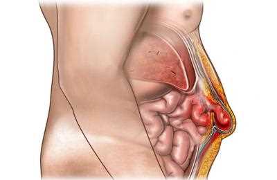 Когда операция при грыже становится необходимостью