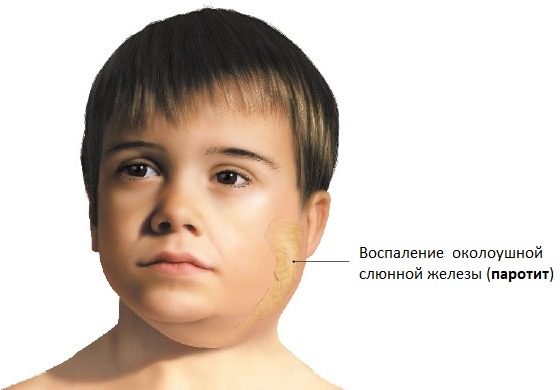 у ребенка опухла щека