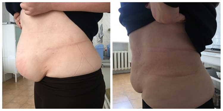 Осложнения грыжи и их риски что нужно знать