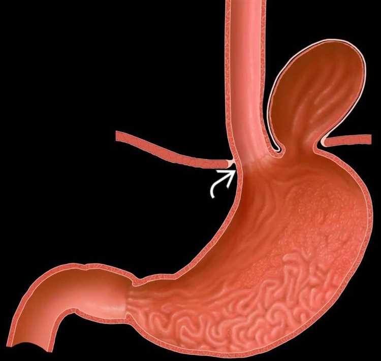 Как избежать осложнений при грыже