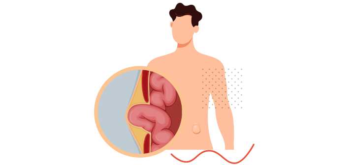 Осложнения после операции по удалению грыжи что нужно знать