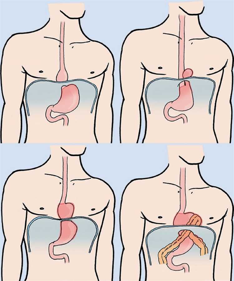Осложнения открытой хирургии грыжи и способы их профилактики