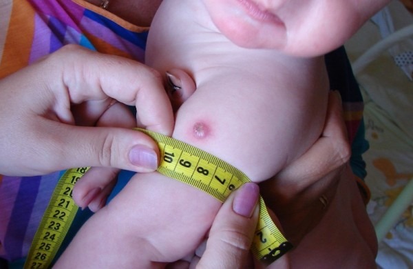 отметка от БЦЖ