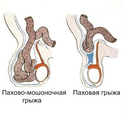 паховая грыжа