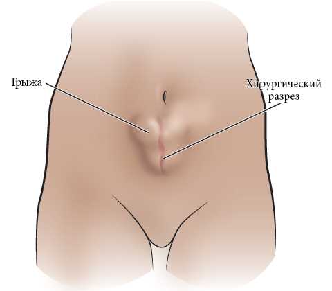 Питание после операции по удалению грыжи Рекомендации и советы