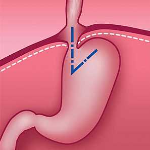 Правильное питание при диафрагмальной грыже что можно и что нельзя