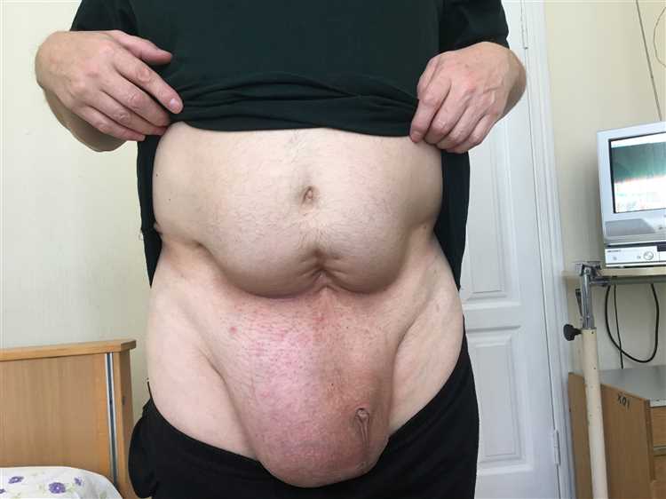 Основные причины и механизмы возникновения грыжи